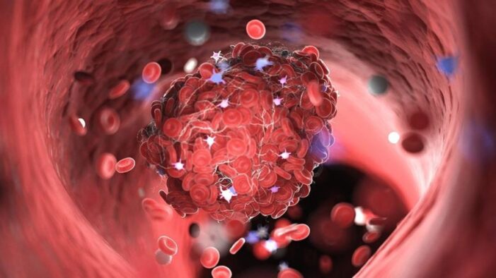 (COVID-19) Hareketsizlik: Pandemide pıhtı riski arttı!..