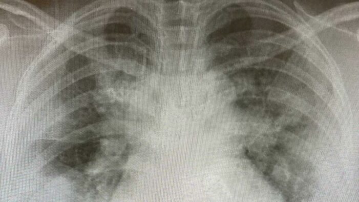 COVID-19: Yoğun bakımlar gençlerle dolu