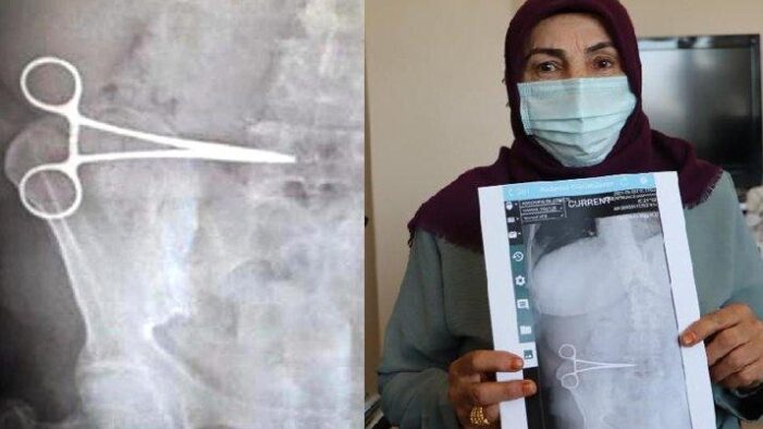 Operasyon sırasında karnında makas unutuldu