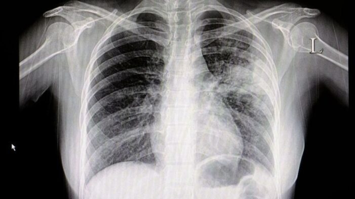 Coronaya yakalanan gençler konuştu: Bir ay sürdü!..