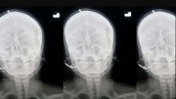 Erkek çocuk doğurmak için kafasına 5 santimlik çivi çaktırdı