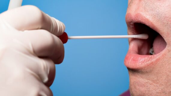 Prostat kanserini erken teşhis için tükürük testi geliştirildi