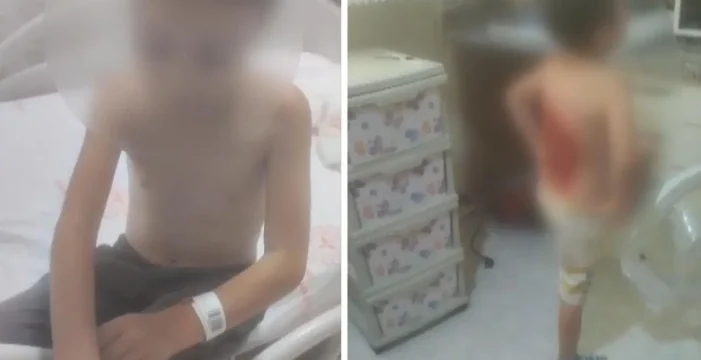 Arnavutköy’de akran şiddeti: 12 yaşındaki çocuğu kolonya döküp yaktılar..