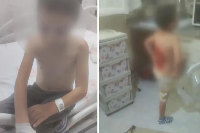 Arnavutköy’de akran şiddeti: 12 yaşındaki çocuğu kolonya döküp yaktılar..